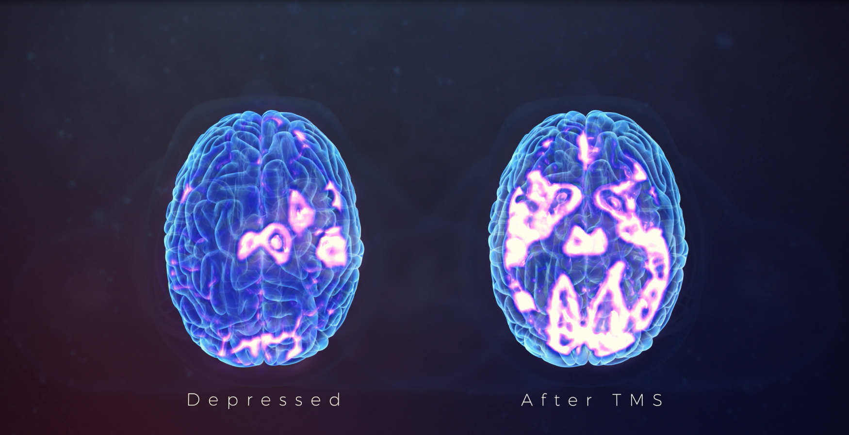 mri depression